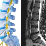 Resonancia lumbar