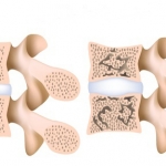 osteoporosis espalda