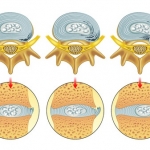 Disco intervertebral