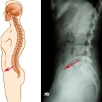 Listesis (espondilolisis/espondilolistesis)