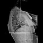 Hipercifosis y Scheuermann