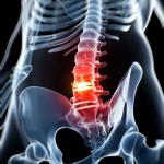 Discitis y osteomielitis vertebral
