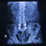Artrodesis lumbar