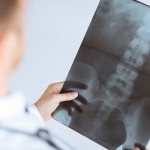 Ángulo de Cobb y escoliosis