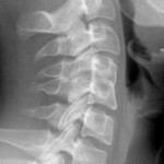 Fusión de vértebras cervicales (Klippel-Feil)