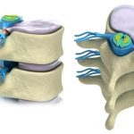Protrusión discal