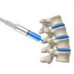 Ozono y hernia discal