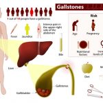 Piedras en la vesícula y dolor de espalda