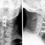 Cirugía de la hernia cervical