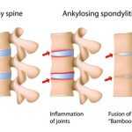 Espondilitis anquilosante (EA)