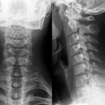 Rectificación cervical