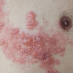 Herpes Zoster