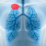 Tumor de Pancoast