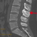 Osteoma osteoide en la columna
