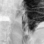 Vertebroplastia y cifoplastia en fractura vertebral