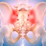Sacroileitis