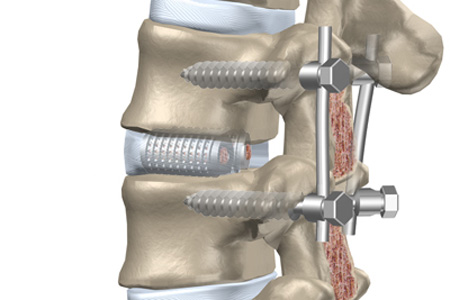 Artrodesis Intersom tica Lumbar Posterior PLIF 